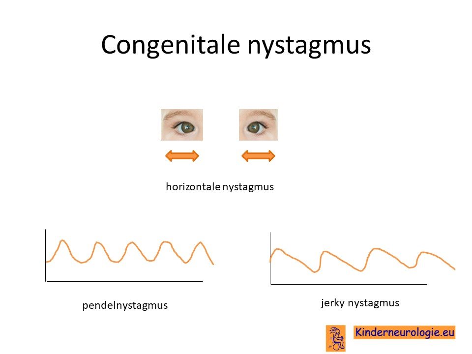 congenitale nystagmus